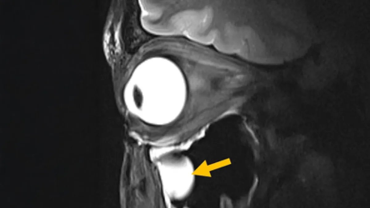 Metamaterial MRI upgrade sharpens brain, eye scans in less time