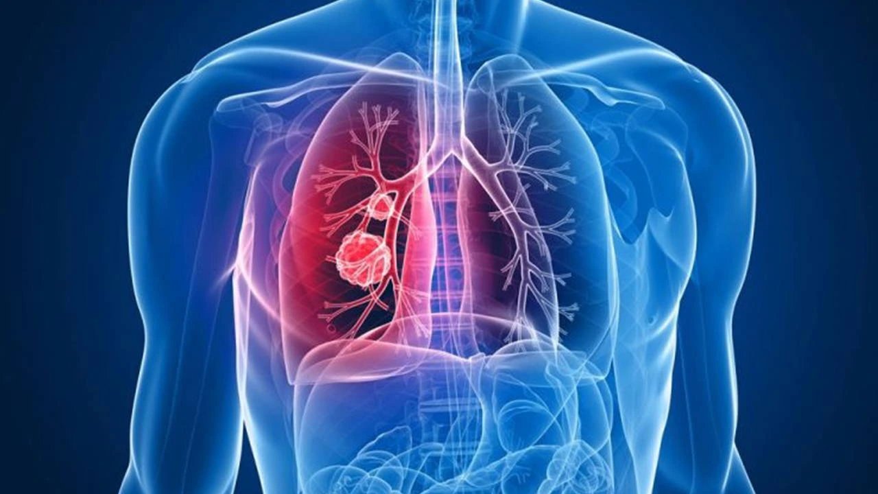 Blood markers predict lung cancer risk years before diagnosis, study finds