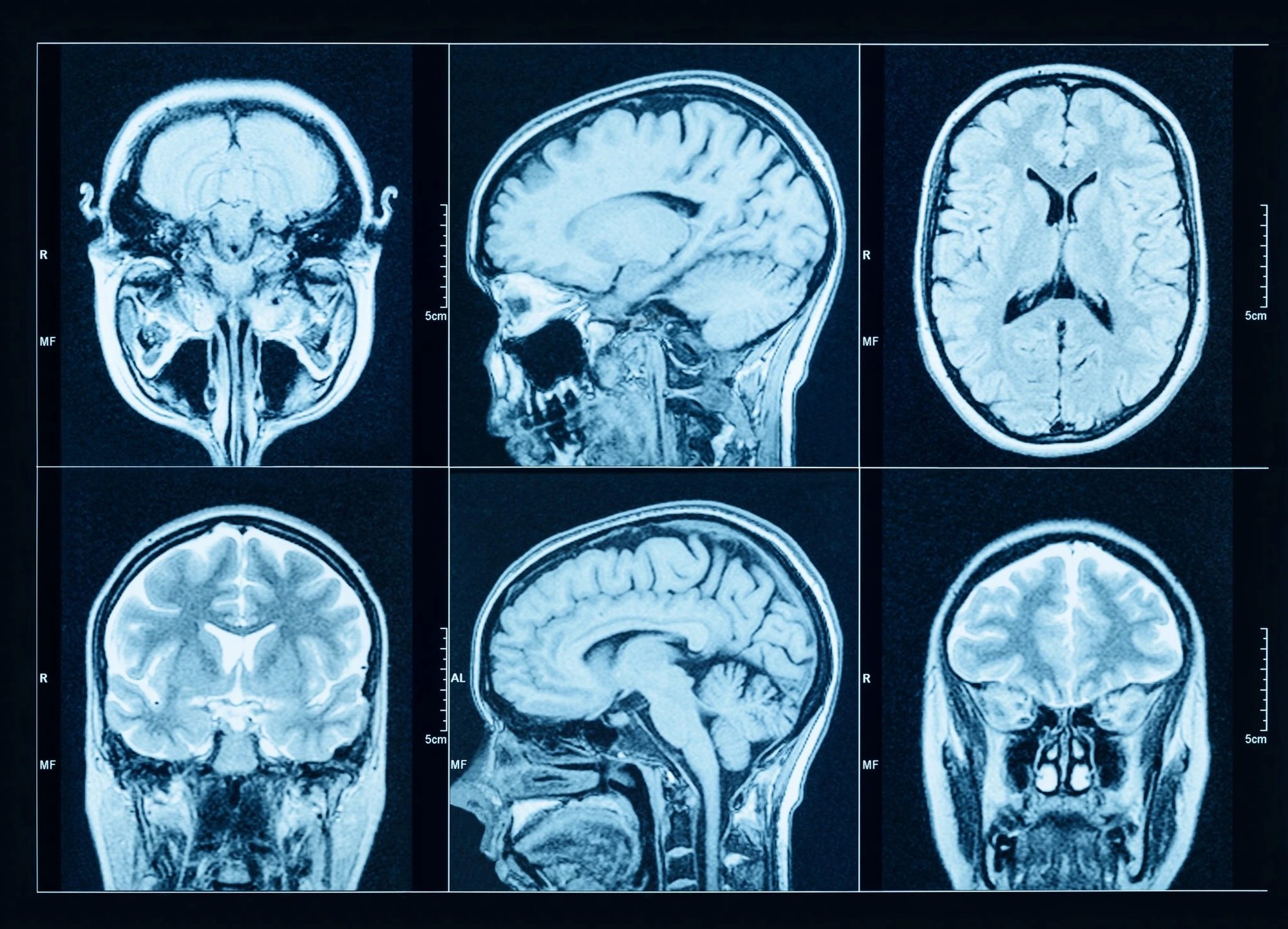 Blood-thinning medication linked to slower cognitive decline