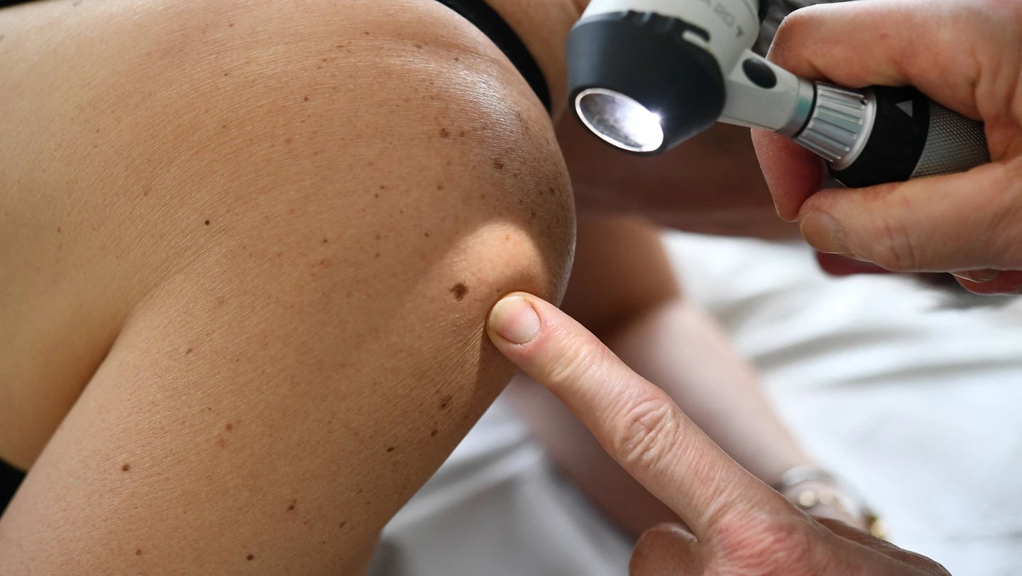 Moderna-Merck melanoma vaccine with Keytruda extends cancer-free survival in trial