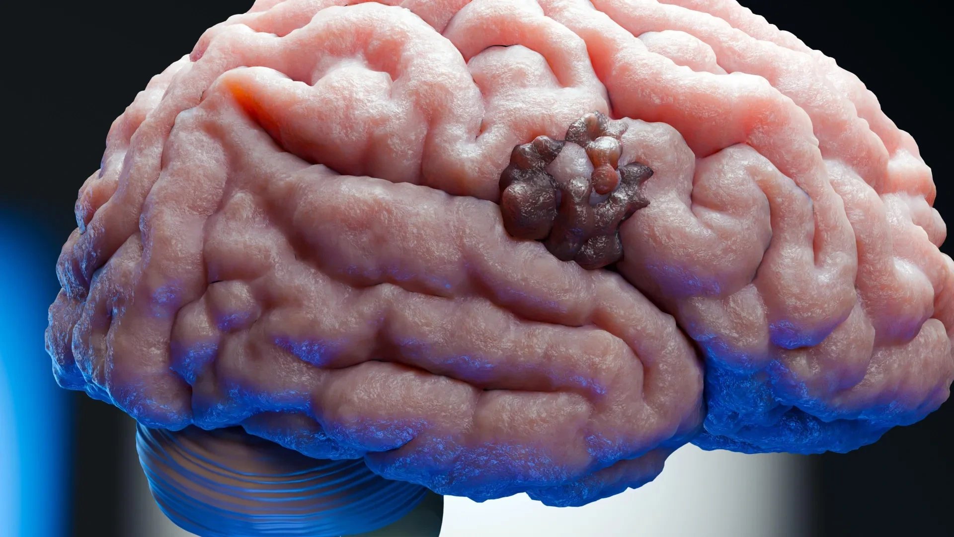 Ohio State researchers identify SET protein as glioblastoma treatment target