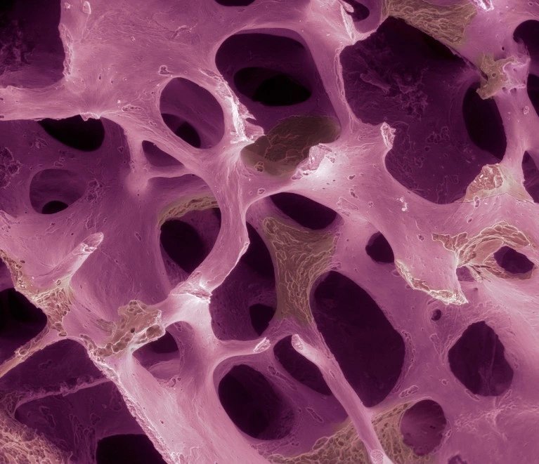 Modified bone-marrow cells nearly stop fractures in osteoporosis trial