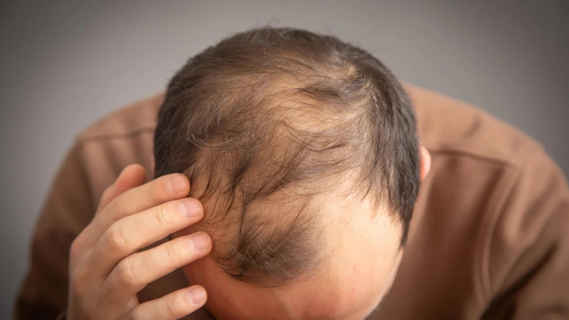 GLP-1 drugs like Ozempic linked to 7% higher hair loss risk in men