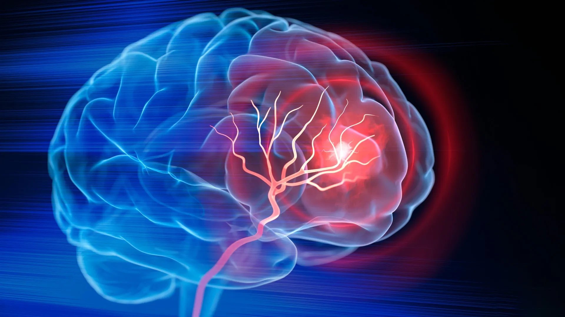 Mount Sinai studies find APOE4 brain vessel damage may be reversible