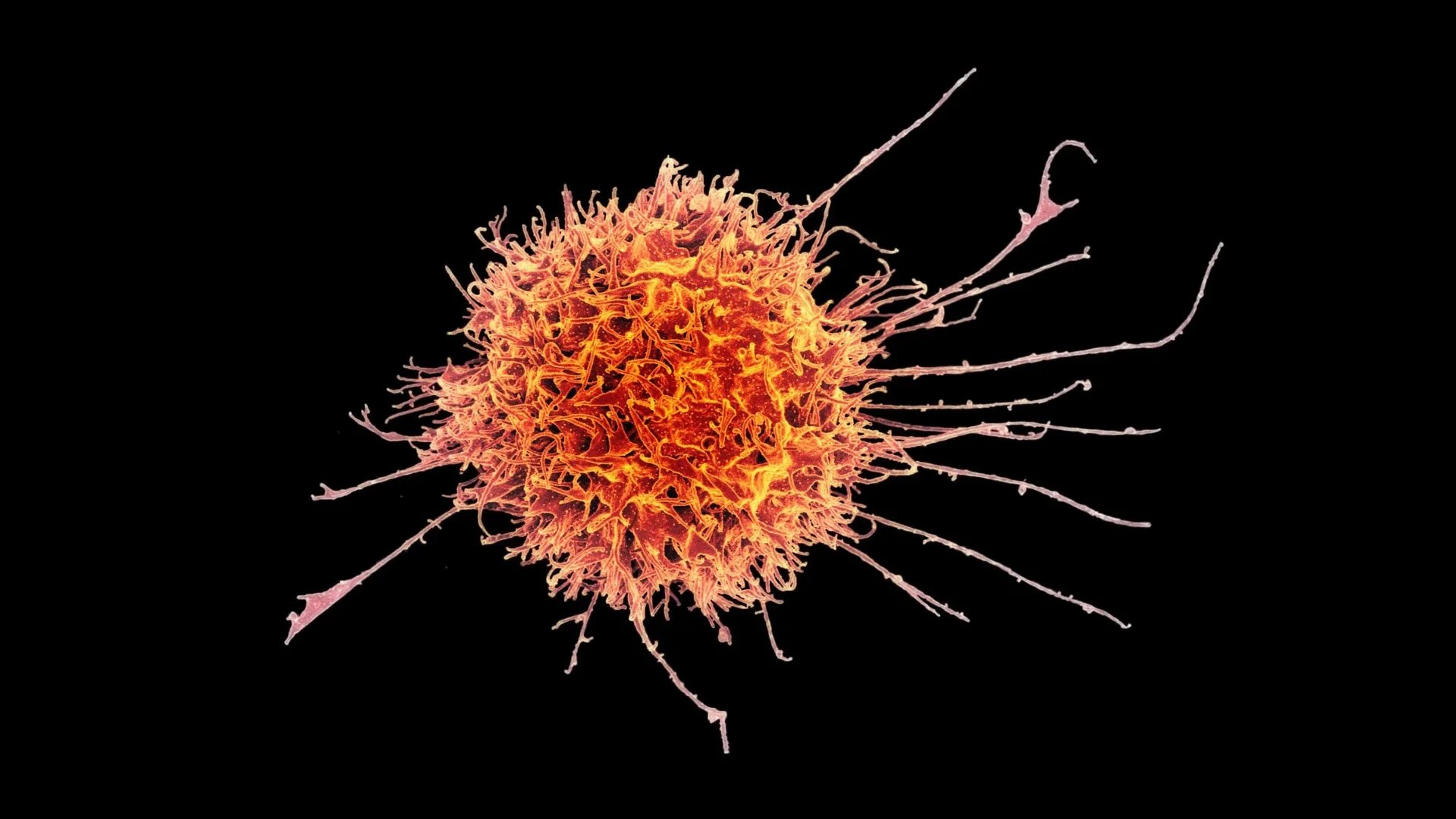 Stanford researchers engineer natural killer cells to infiltrate solid tumors