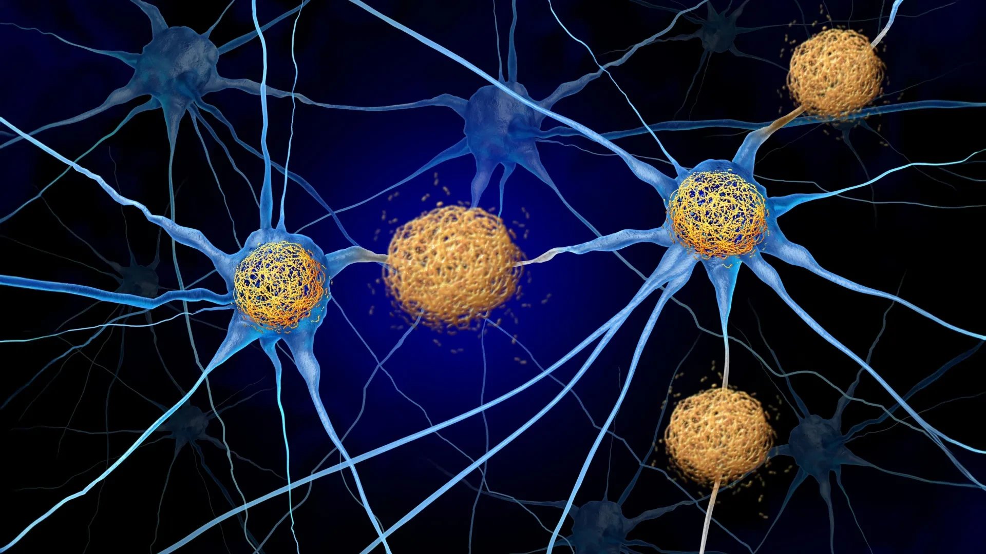 Brain changes appear seven years before Alzheimer's plaques, study finds