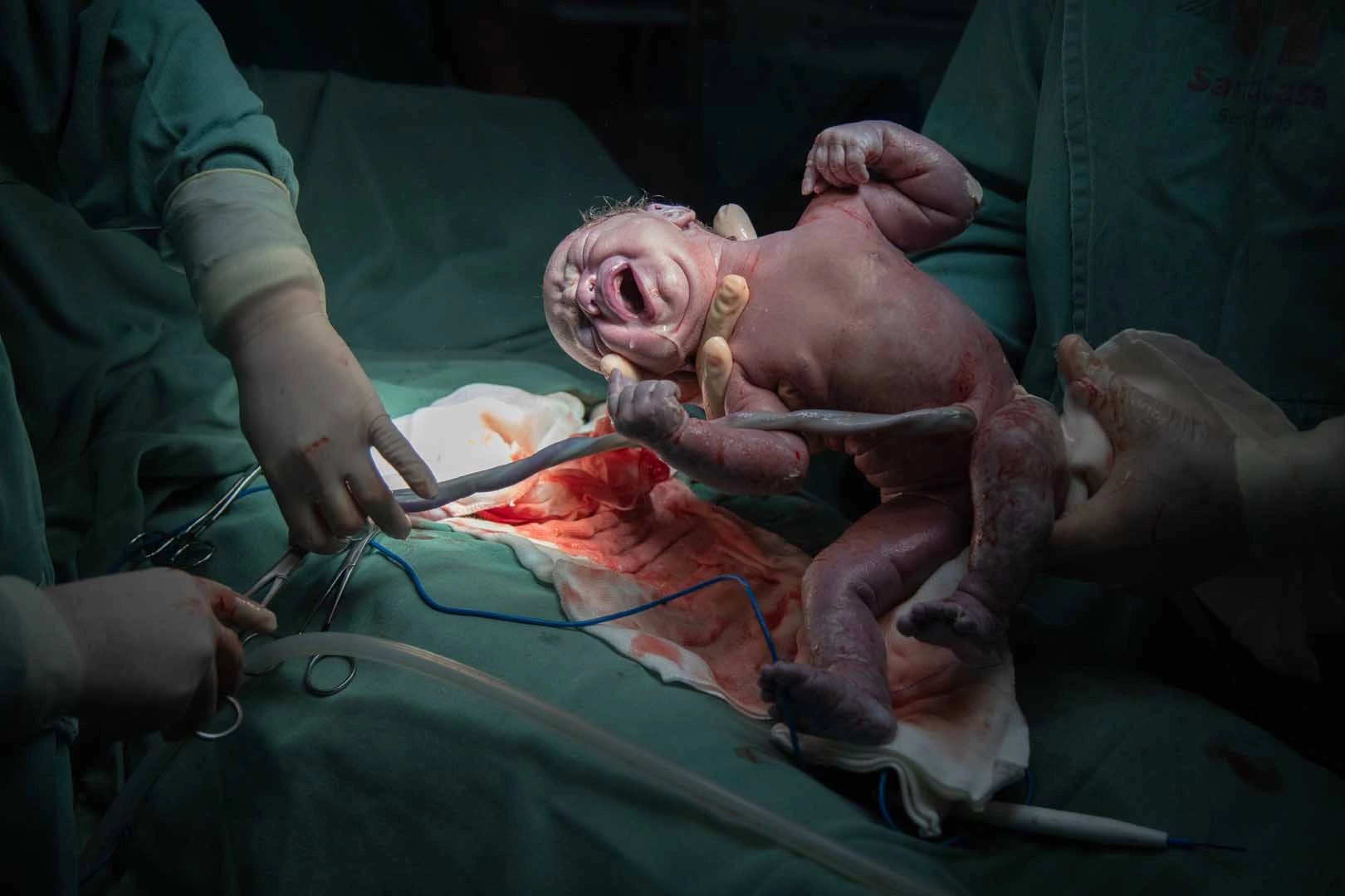 Turkish doctors warn cesarean crackdown risks women's health